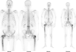 Technetium bone scintigraphy99. Increased uptake in the upper left femur.