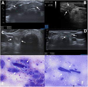 Representative images of some of the lesions with foreign body reaction to oxidised cellulose (FBR-OC). A) Pretracheal hypoechoic image, lobulated, elongated and well-defined, suggesting thyroid tissue, less likely haematoma. B) Well-defined nodular hypoechoic left paratracheal image, non-vascularised and with triangular morphology, like a "tear", suggesting post-surgical debris or haematoma. C) Hypoechoic right paratracheal image, very similar to the previous one, with central echogenic content suggestive of haematoma, but with recommendation to perform fine needle aspiration (FNA). D) Nodular isoechoic lesion with well-defined margins and tear-shaped morphology in the left surgical site. E) Rectangular, acellular and elongated structure associated with an inflammatory component consisting of macrophages and a protein-based background (40×, Diff Quick). F) Rectangular, acellular and elongated structure, on a protein-based background and without inflammatory components (40×, Diff Quick).