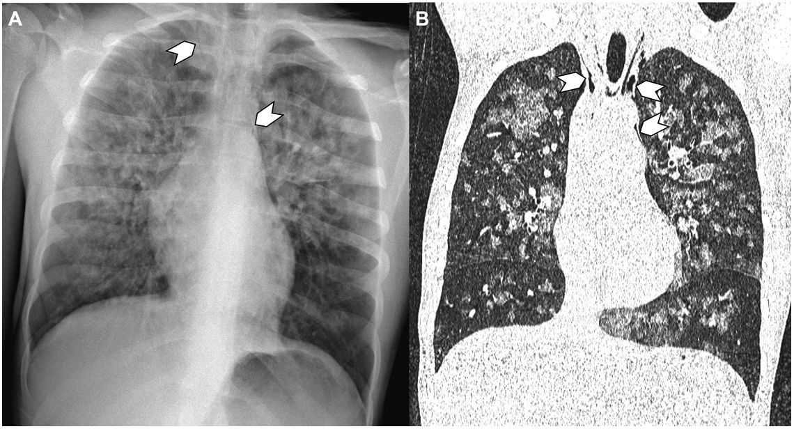 Negative pressure non-cardiogenic pulmonary edema with concomitant