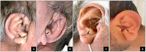 Diagonal ear lobe crease (Frank's sign) morphology. (A, B) A 65-year-old male patient showing Frank's sign with complete and bilateral morphology, with two-vessel disease, one of them with chronic total occlusion. (C) A 59-year-old female patient with Frank's sign with complete and unilateral morphology and two-vessel disease. (D) A 49-year-old male with Frank's sign with incomplete and unilateral morphology and three-vessel disease. Frank's sign is indicated by the arrow.