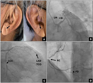 Representative case of a patient showing Frank's and severe coronary artery disease. (A) A 62-year-old male with complete and bilateral morphology of Frank's sign (arrow). (B) Coronary angiography exhibits distal left main (LM) disease occlusion of 40% (arrow). (C) Left anterior descending (LAD) with total chronic occlusion (TCO) (arrow) and left circumflex artery (LCX) with distal 70% lumen occlusion (arrowhead). (D) Right coronary artery (RC) with a 60% lesion (arrow) and a 90% lesion (arrowhead) in posterior descending artery (PD).