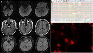 Magnetic resonance imaging (MRI) (A), electroencephalography (EEG) (B), anti-LGI1 antibody protein expression in cerebrospinal fluid (CSF) (C), of case 1.