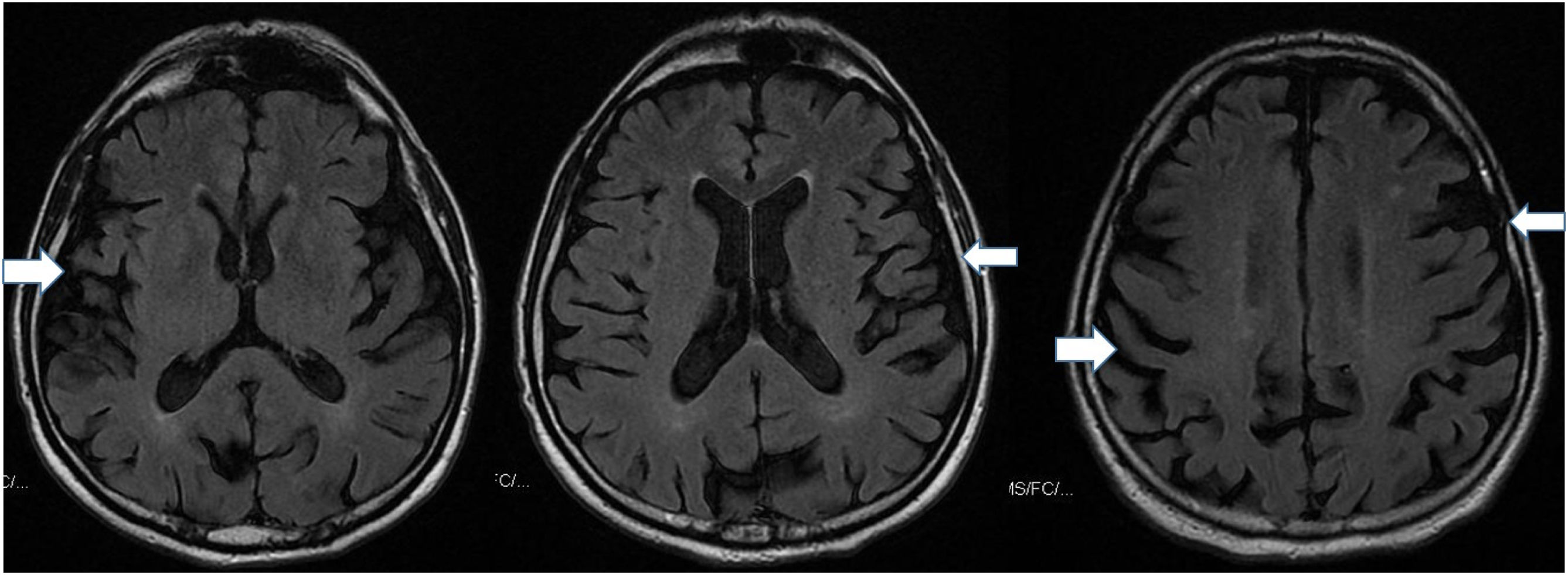 Early cortical atrophy in REM sleep behavior disorder | Medicina ...