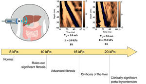 Estimation of the degree of liver fibrosis by transient elastography and "rule of 5" for the risk of liver cirrhosis. Note: The "rule of 5" should be treated with caution as it has not been clearly demonstrated, particularly in general population studies. Adapted from Refs.1,2,37