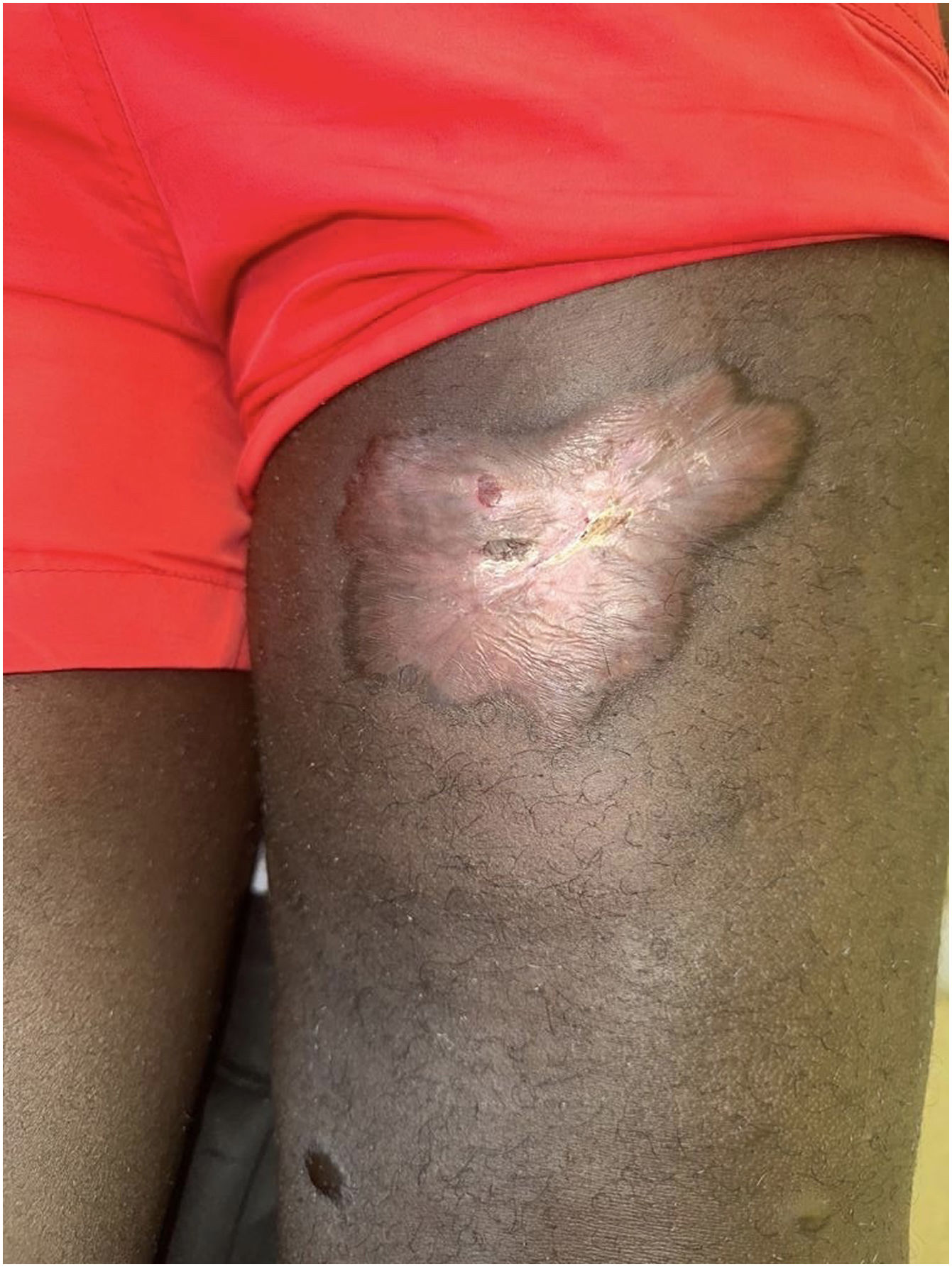 cutaneous diphtheria pictures