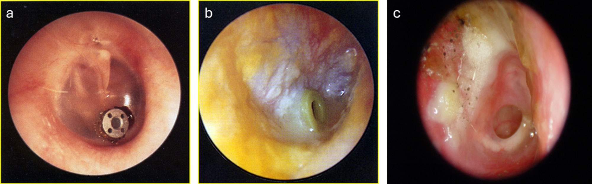 chronic otitis media pathology outlines