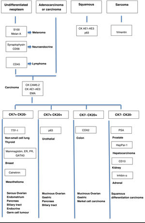 Algorithm for the diagnosis of cancer of unknown primary using immunohistochemistry. CAM5.2: antibody against low molecular weight cytokeratins; CDX2: colorectal cancer marker; CD10: metalloproteinase expressed in B-cell lymphomas; CK AE1/AE3: cytokeratin AE1/AE3; CK7: cytokeratin 7; CK20: cytokeratin 20; EMA: epithelial membrane antigen; GATA3: transcription factor associated with breast and urothelial tumours; HepPar-1: hepatocyte paraffin 1; LCA: leukocyte common antigen; NCAM: neural cell adhesion molecule; PSA: prostate-specific antigen; p63: transcription factor related to p53; ER: oestrogen receptor; PR: progesterone receptor; S100: protein of the S100 family with a role in cell signalling; TTF1: thyroid transcription factor 1. Modified from Losa et al.4