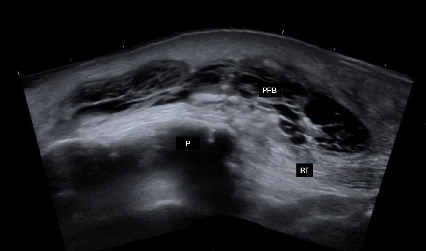 Ultrasound in the study of soft tissue infections | Medicina Clínica ...