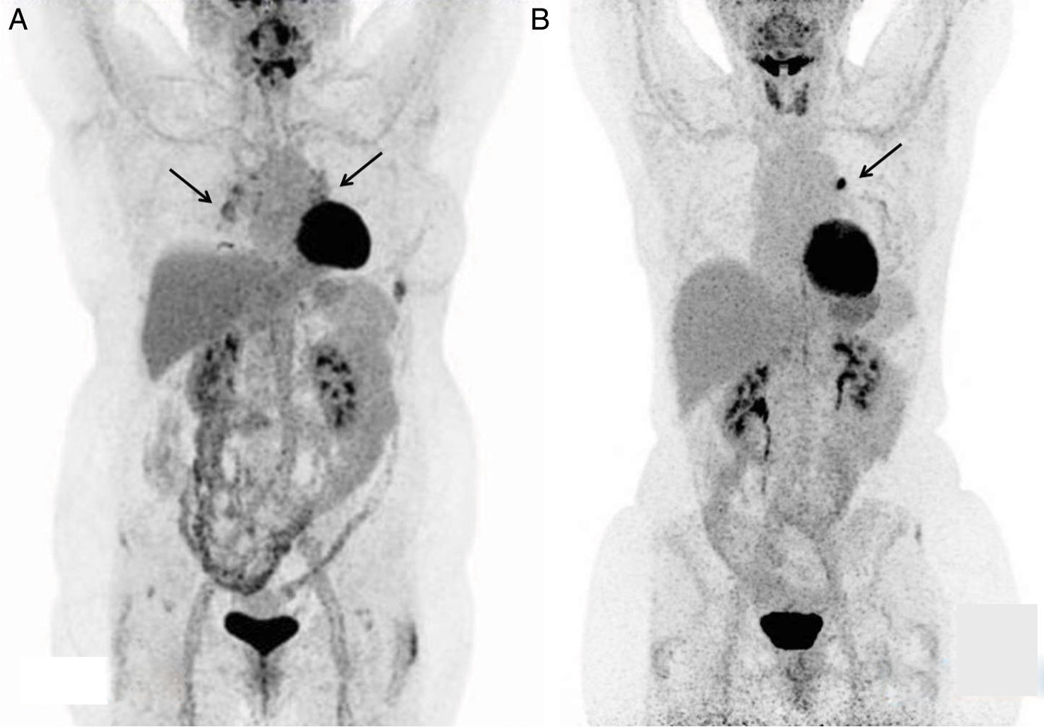 sarcoid-like-reaction-associated-with-her2-treatment-in-patients-with