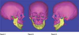 Mediciones cefalométricas tridimensionales obtenidas de la tomografía axial computarizada con ayuda del programa Simplant, utilizando algunas medidas del análisis de Ricketts, Steiner y Bigerstaff.