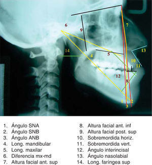 Mediciones cefalométricas bidimensionales obtenidas de la cefalometría lateral de cráneo, utilizando algunas medidas del análisis de Ricketts, Steiner y Bigerstaff.