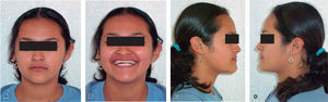 Fotos extraorales: A. vista frontal, B. vista frontal en sonrisa, C. y D. perfil derecho e izquierdo.