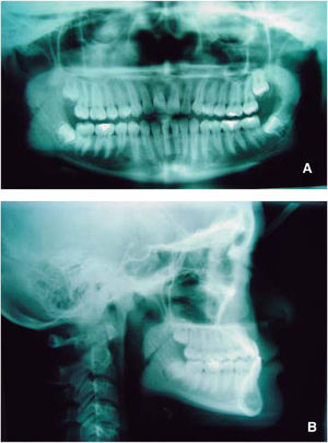 Radiografías de inicio del tratamiento: A. ortopantomografía, B. lateral de cráneo.