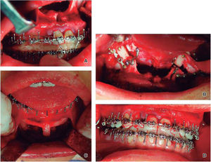Fotos de la cirugía: A. colocación de férula quirúrgica, B. fijación, C. toma de injertos de mentón, D. oclusión final quirúrgica.