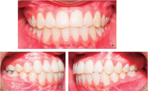 Fotos intraorales terminado: A. vista frontal, B. lateral derecha, C. lateral.