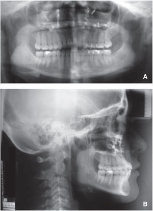 Radiografías finales: A. ortopantomografía, B. lateral de cráneo.