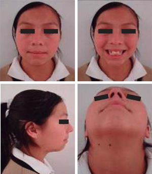 Fotografías faciales pretratamiento.