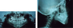 Radiografías panorámica y lateral de cráneo postratamiento.