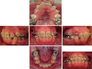 Se retira botón y se coloca brackets de canino #13.