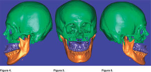 Virtual simulation of the surgery based on the data obtained from tridimensional cephalometry.