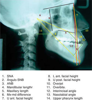 Cephalometric bidimensional measurementsobtaned from the lateral cephalography using some measurements of the Ricketts, Steiner and Bigerstaff.