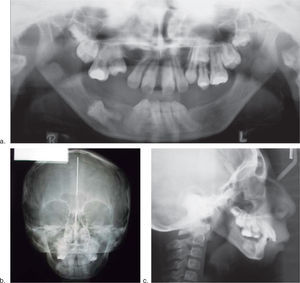 Radiographic study where the short mandibular, ramus and the oligodonthia can be observed. 2a. Panoramic radiograph. 2b. PA radiograph. 2c. Lateral cephalogram.
