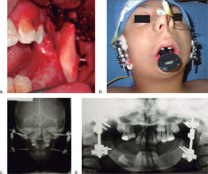Surgical procedure. 3a. Corticotomy of the ramus. 3b. Extraoral distractors in position. 3c. PA radiograph with full distraction. 3d. Panoramic radiograph before distractors removal.