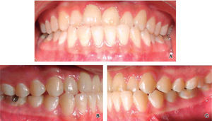 Intraoral photographs: A. frontal view, B. right view, C. left view.