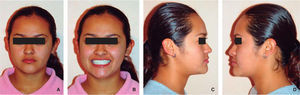 Final extraoral photographs: A. frontal view, B. smile, C. y D. right and left profile.