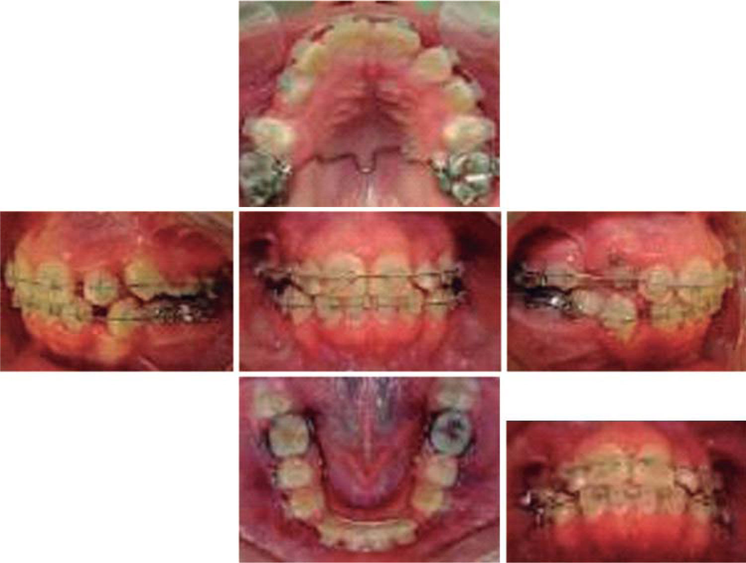 Orthodontic traction of a retained upper canine with Edgewise appliances:  Case report