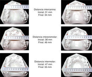 Comparación de las medidas oclusales transversales (cúspide-cúspide).