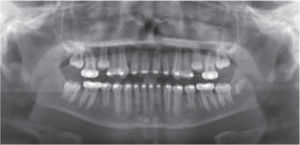 Décimo séptimo mes: ortopantomografía de control donde se observó la disminución del defecto óseo en la periferia del incisivo central superior derecho y buen paralelismo radicular. También se observó la aproximación de los segundos premolares superiores a la cavidad oral.