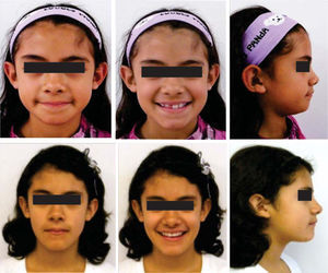 Comparativa de fotografías extraorales iniciales y finales: se observa armonía facial y el mínimo cambio en el perfil después del tratamiento.