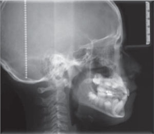 Radiografía lateral de cráneo.
