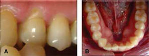 Cases of: A) fluoride release and B) short treatment.