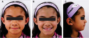 Initial extraoral photographs. Extraoral clinical inspection: A) frontal photograph, B) smile photograph, C) lateral photograph. A moderate facial asymmetry and a slightly convex proﬁ le is observed in the photographs.