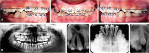 On the 13th month: A) upper right central incisor in the dental arch, B) radiographic evaluation where a bony defect was observed around the upper right central incisor and the root dilacerations on the central and lateral incisors. The root of the upper right canine is almost completely formed and with a tendency towards impaction.