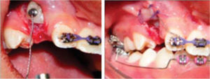 Next appointment: a second surgery was performed for the exposure of the upper right canine and a button was placed for orthodontic traction.