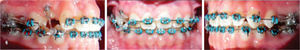 14th month: the accessory arch was removed and brackets for the erupted canines and premolars were placed. A 0.016×0.016 stainless steel archwire was placed with a box bend for traction of the canine with elastic ligature. On the lower arch a NiTi archwire was placed.