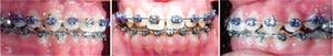 Four months after (month 21): the upper second premolars were completely erupted. A 0.022 MBT bracket was placed upside down on the upper right central incisor to provide negative torque. 0.017×0.025 NiTi archwires were placed.