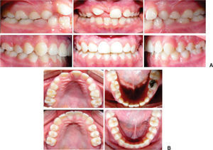 Pre and post treatment intraoral photographs: A) upper right incisor and canine were aligned into the dental arch. Obtained molar and canine class I, B) obtention of ovoidal arch forms.