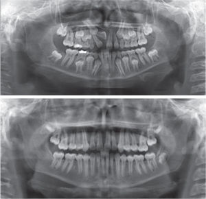Initial and ﬁnal panoramic radiograph: Acceptable root paralellism and integrity are observed.