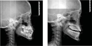 Lateral head ﬁlm.