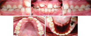 Initial intraoral photographs. Intraoral clinical inspection: A) right lateral radiograph: a molar class I is observed and canine class I (of primary canines), B) frontal photograph: it is possible to observe the space loss for the eruption of the right central incisor and the inclination of the lateral incisor, C) left lateral photograph: a molar class I (permanent) and a canine class I (primary) are observed, D) upper and lower occlusal views: an ovoidal arch form is observed and lower anterior interproximal spaces.
