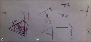 A) Ricketts superimposition: pretreatment and postreatment observed changes. It is observed that there was growth and minimal changes on the profile, B) 7 areas for assessment according to Ricketts: observed changes in the beginning and at the end of treatment.