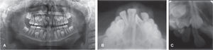Initial radiographs. A) Panoramic radiograph: the impaction of the upper right central incisor in a horizontal position can be observed and the canine’s mesial displacement with a tendency for impaction. B) Occlusal radiograph: the location of the central incisor is labia. C) Dentoalveolar radiograph where the displacement of the upper right canine and its tendency for impaction may be observed.
