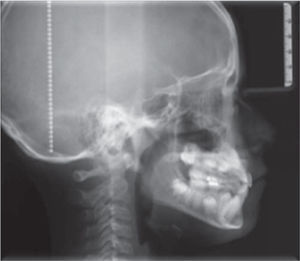 Lateral head ﬁlm.