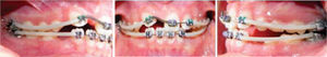 First month: 4×2 fixed appliances placement (Edgewise, slot 0.022×0.025) with 0.014 NiTi archwires and space opening for the upper right central incisor with open coil.