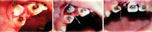 Second month: surgery for the exposure of the upper right central incisor and button placement for orthodontic traction.
