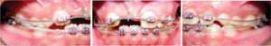 Next appointment: orthodontic traction was initiated with elastic ligature to the archwire. This procedure was performed for four more months.
